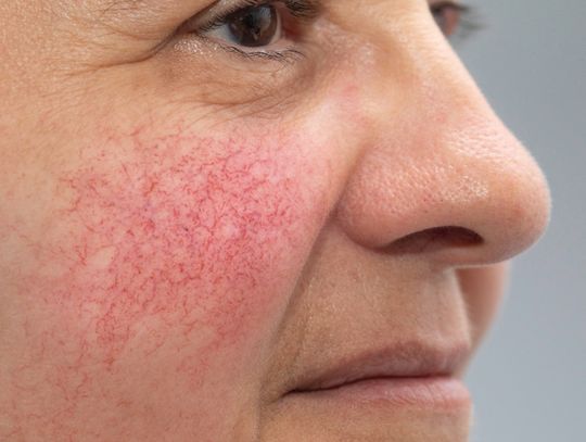 Olej konopny i inne sprawdzone sposoby – jak pielęgnować skórę naczynkową?