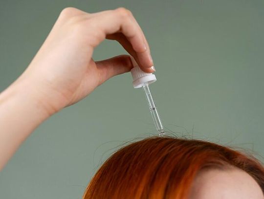 Uciążliwa łuszczyca skóry głowy? Są sposoby